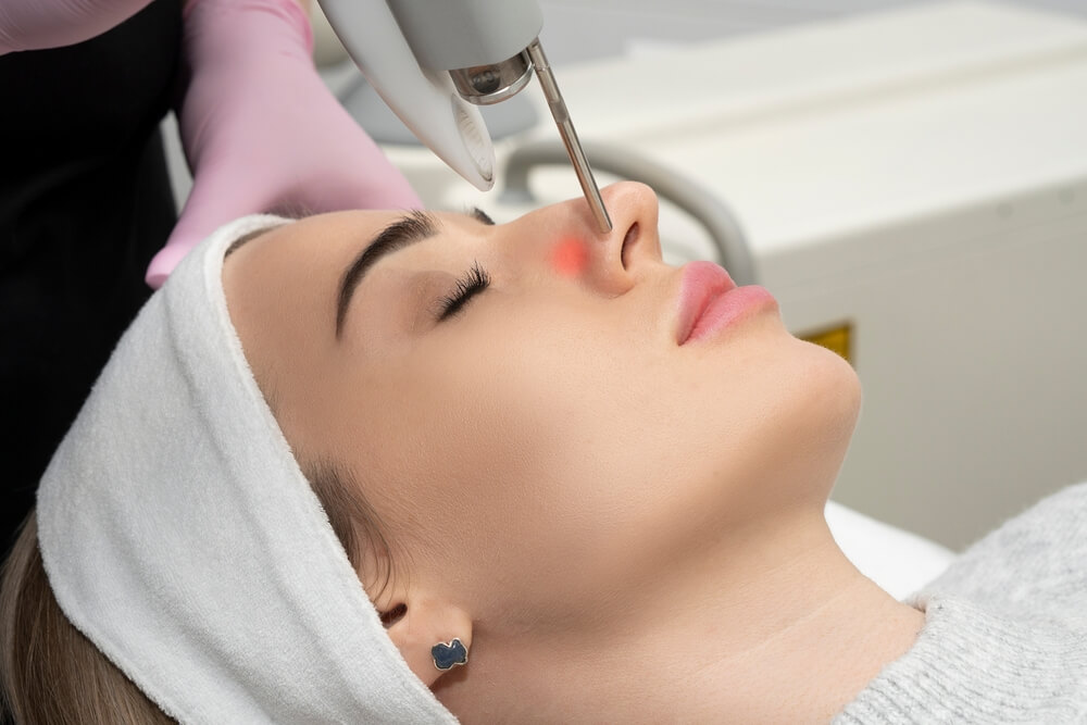 Laser for Hyperpigmentation