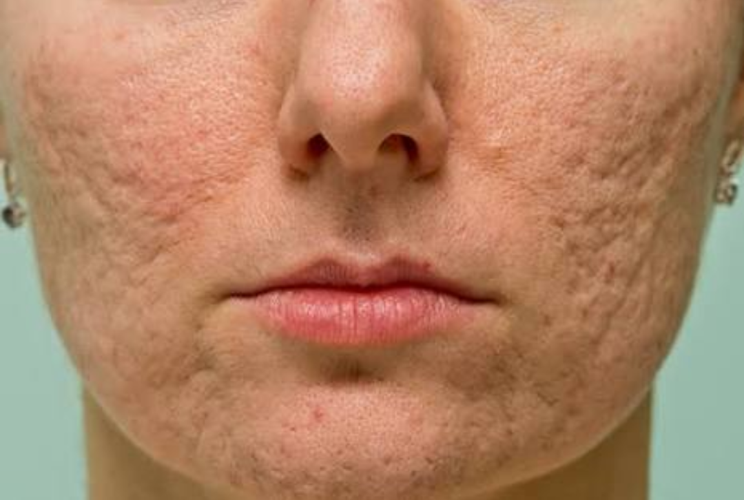 Scars, Keloids, Stretch Marks - Bay Medical Aesthetics