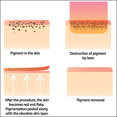 Pigmentation Removal in Melbourne | Vascular Laser Treatment | Bay ...